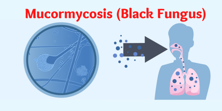 Mucormycosis(Black Fungus)